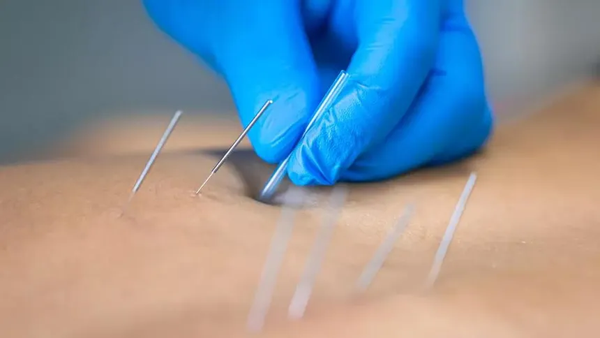 Dry Needling